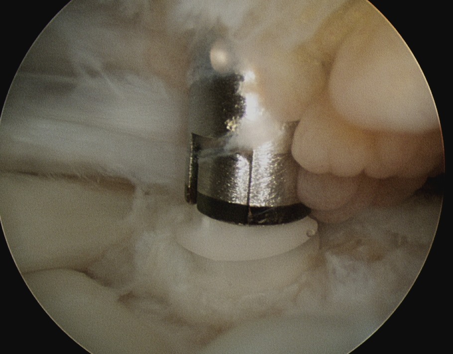 RCR Arthroscopic Anchor